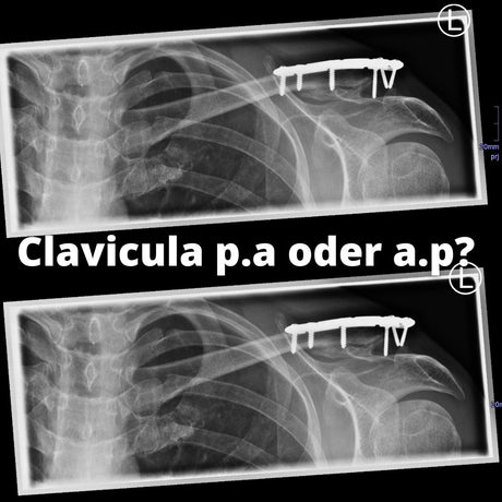 Clavicula p.a. oder a.p. ? - Radcampus